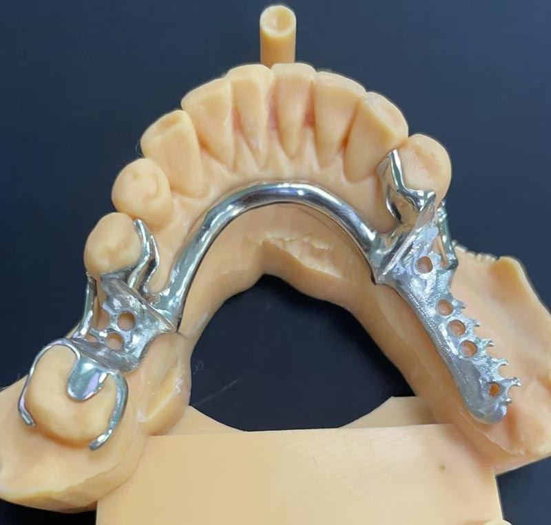 कोबाल्ट-क्रोमियम फ्रेमवर्कचे फायदे (Co Cr फ्रेमवर्क)