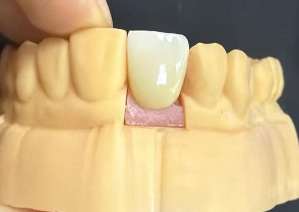 दातांमधील अंतर निश्चित केले जाऊ शकते—सरळ दात सर्वात आकर्षक आहेत!