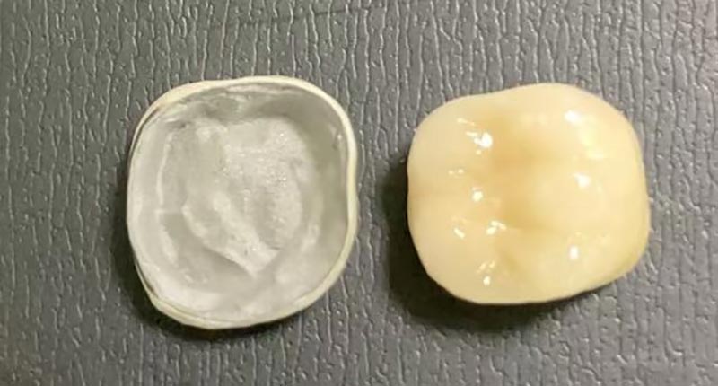 आपल्या पोर्सिलेन मुकुट चिप्स तेव्हा काय करावे? हे का घडते आणि त्याचे निराकरण कसे करावे ते येथे आहे