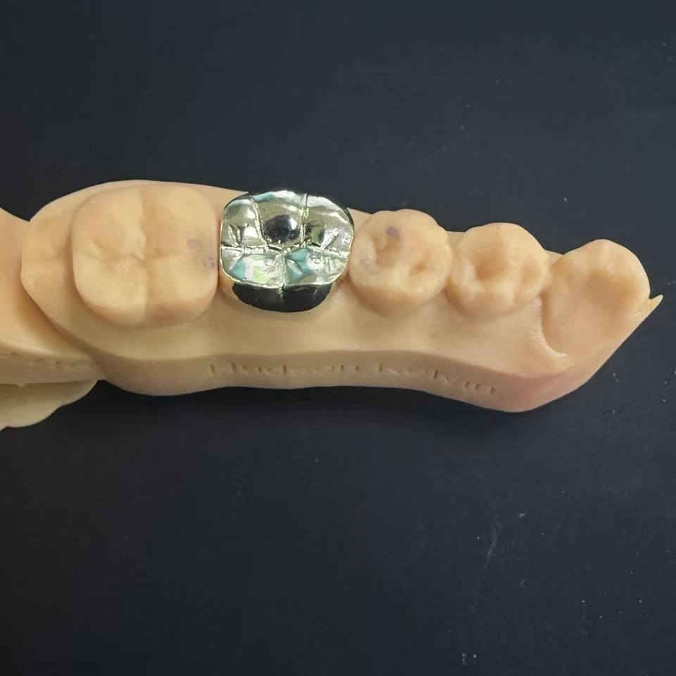 सुवर्ण मुकुट: जीवनभर दंत पुनर्संचयित करण्यासाठी मौल्यवान धातू निवड