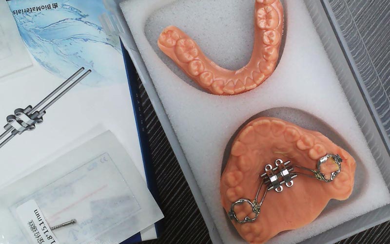 WM डेंटल लॅबसह MSE स्केलेटल विस्तार समजून घ्या