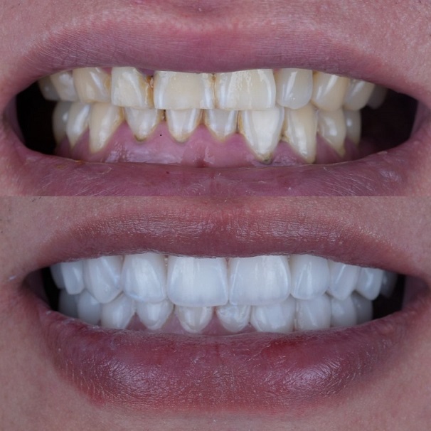 Emax स्तरित Veneers एस्थेटिक चायना डेंटल लॅब काम