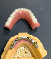 लोकेटर आणि डेंटल बार