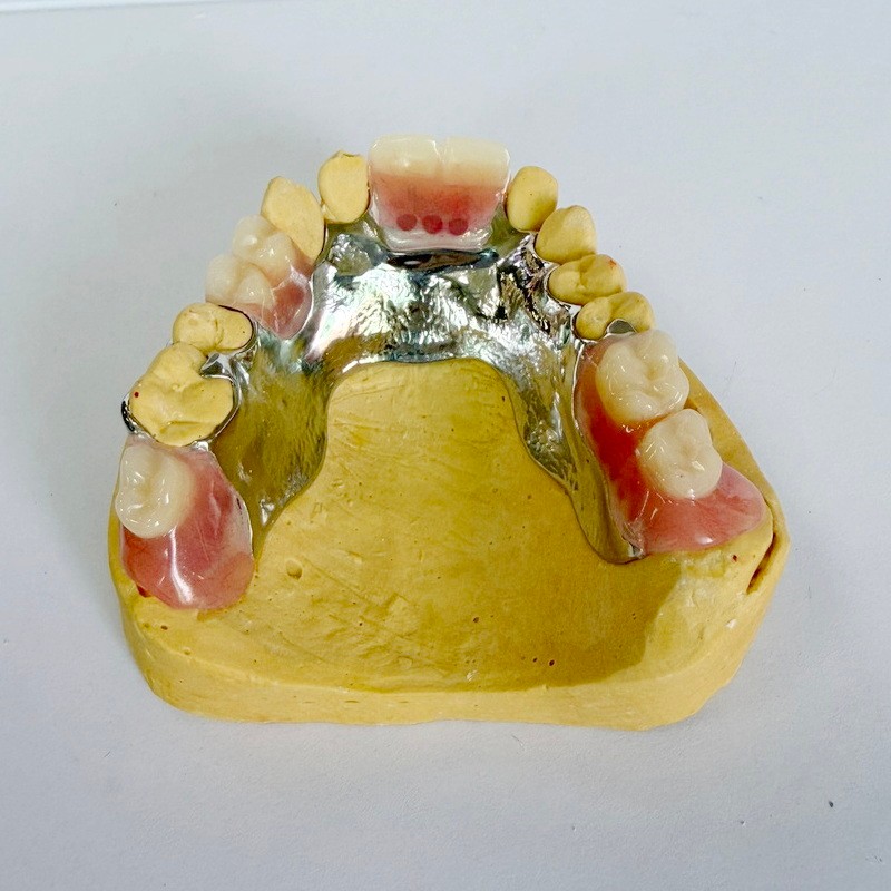 काढता येण्याजोगा जीर्णोद्धार आंशिक फ्रेमवर्क